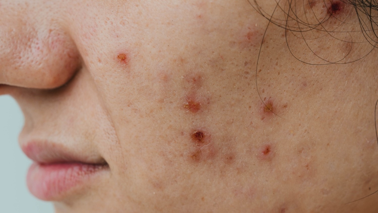 Acne Scars