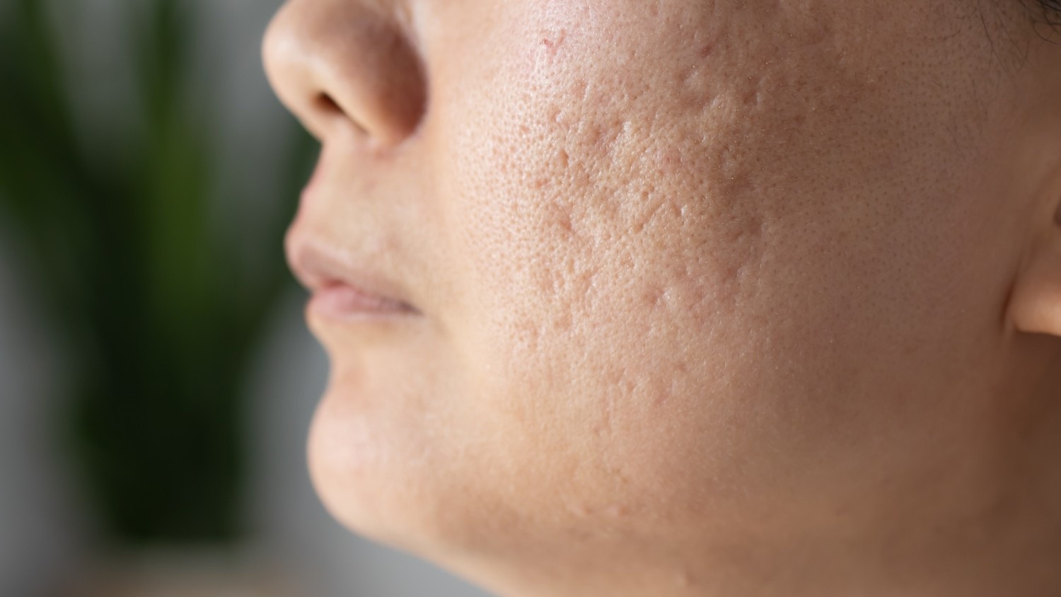 Non-Acne Scars (Surgical or Injury-Related)
