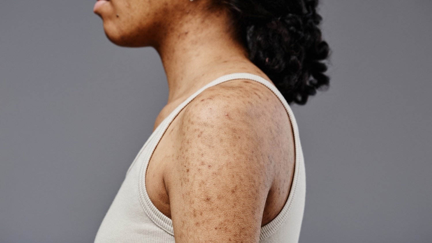 Hyperpigmentation and Sun Spots
