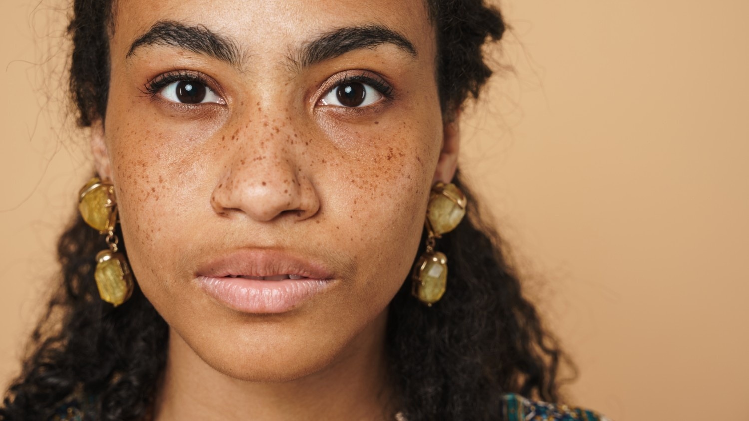 Freckles and Pigmented Lesions