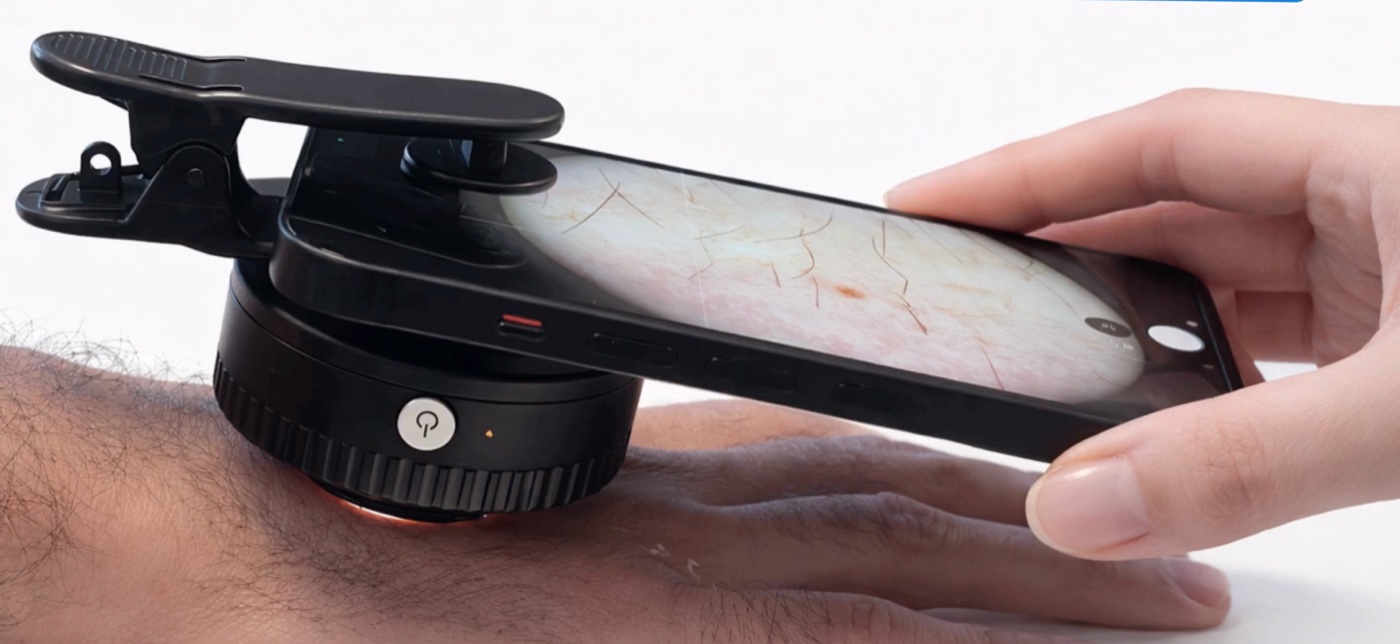Dermatoscope Pictaderm clipsé sur un smartphone et posé sur l'avant-bras, l'écran affichant la peau grossie