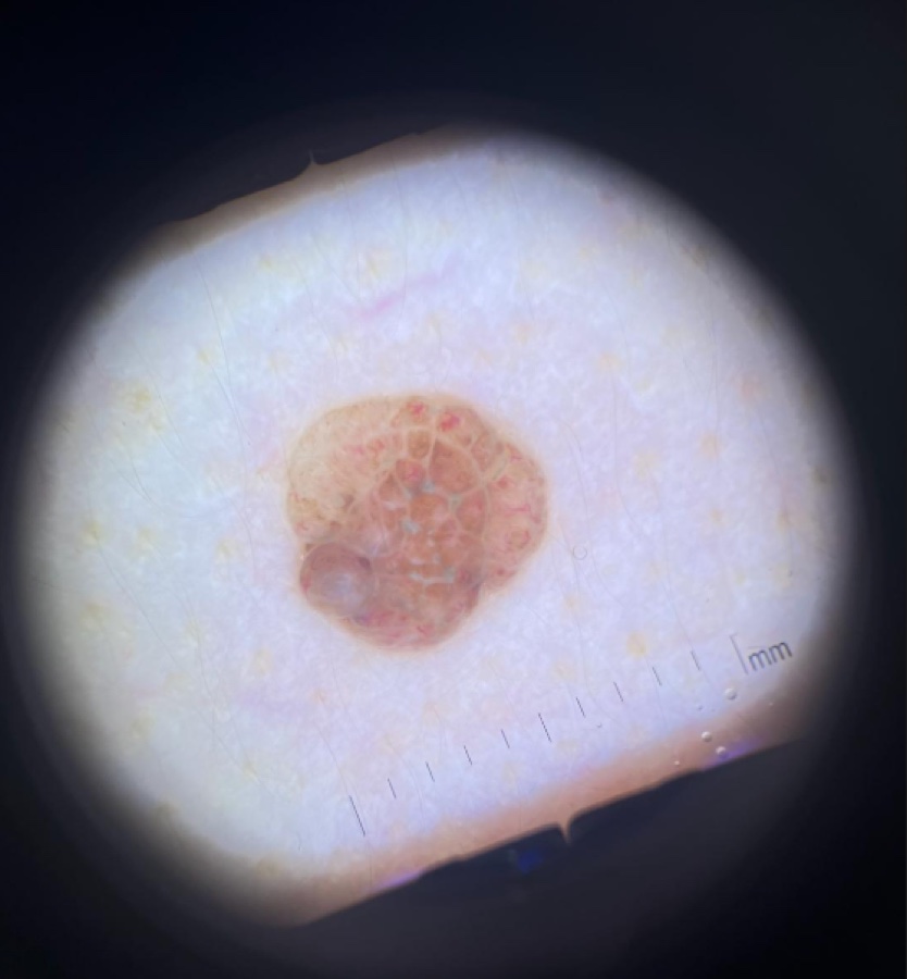 Vue au dermatoscope d'un grain de beauté, avec échelle en millimètres