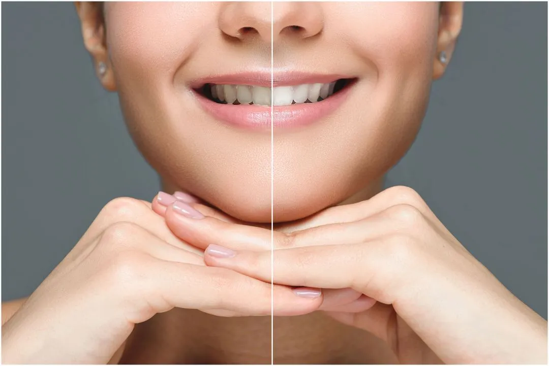 before and after professional whitening treatment