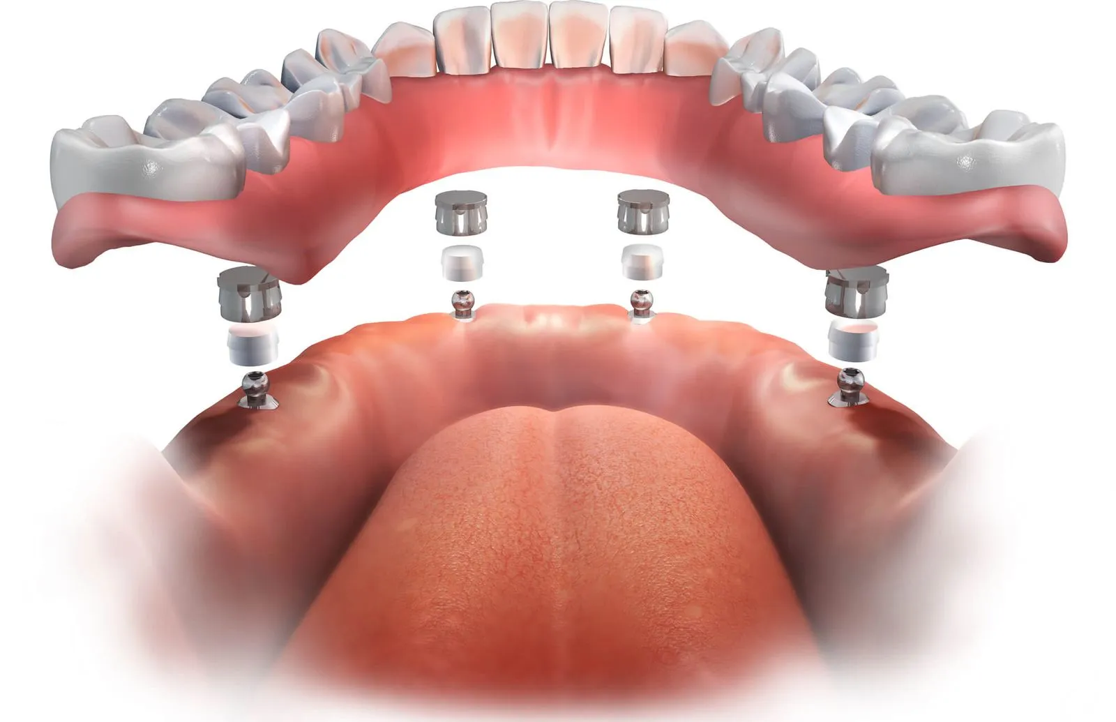 3D image of implant-supported dentures