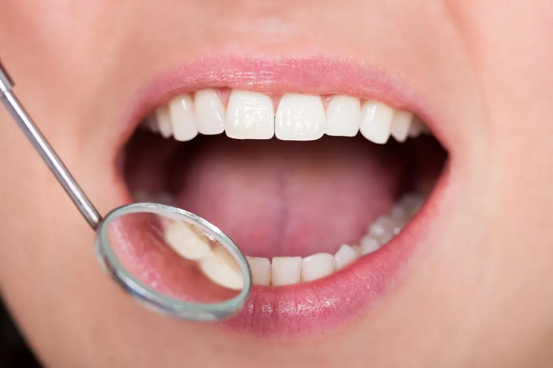 close-up photo of a patient's mouth and a dental mirror