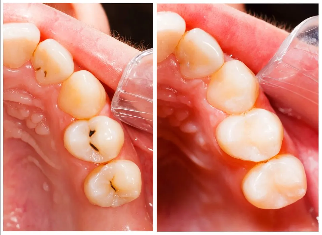before and after dental fillings
