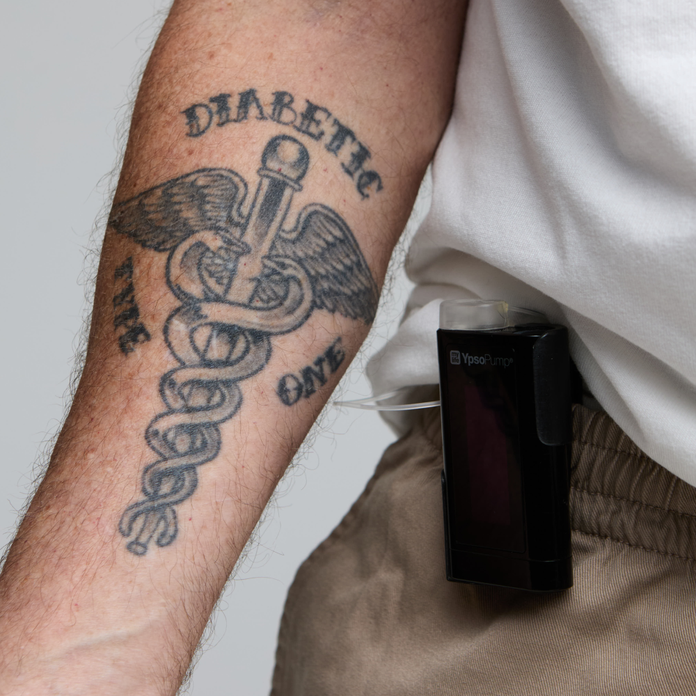 A dexcom G6 continuous glucose monitor (CGM)