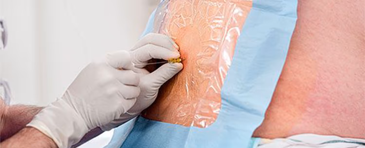 Man in Los Angeles receiving nerve block to manage chronic neuropathic pain