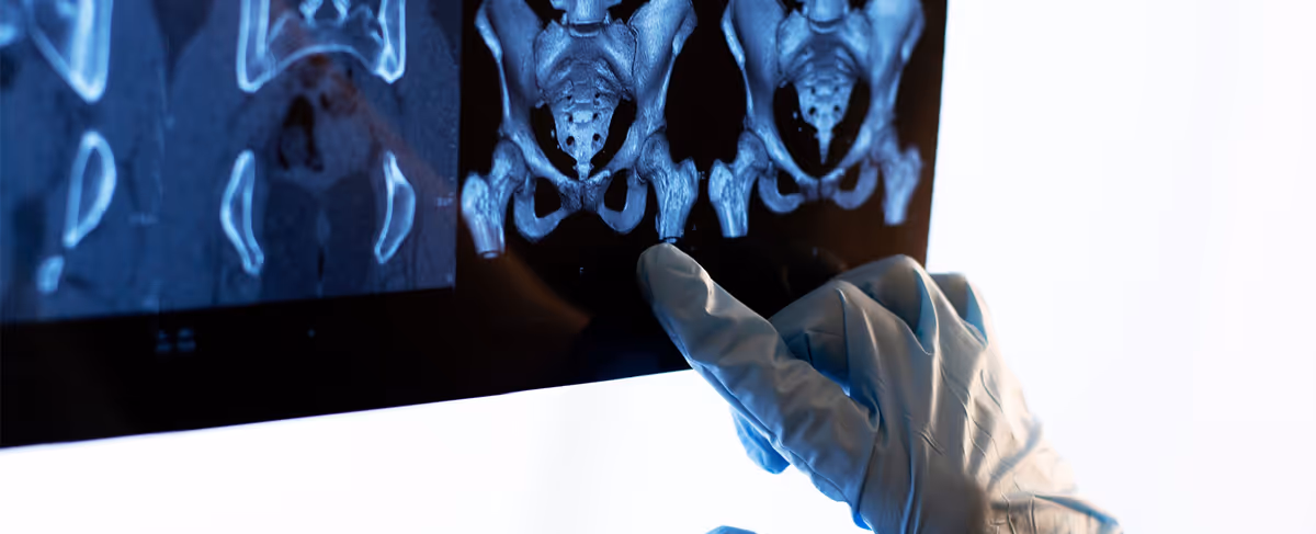 Precision-guided injections in Los Angeles to improve stability and relieve back and pelvic pain.