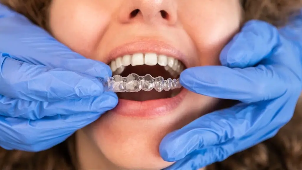 A dentist in blue gloves fits a clear aligner onto a patient's teeth, illustrating the difference between Invisalign vs braces in orthodontic treatments.