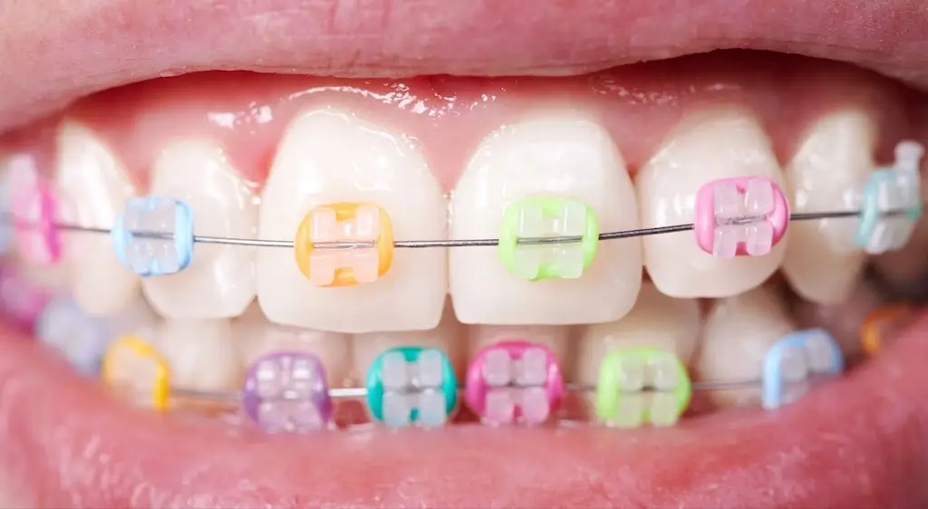 A close-up image of colourful ceramic braces on a patient's teeth, highlighting the traditional braces option in the comparison of Invisalign vs braces.