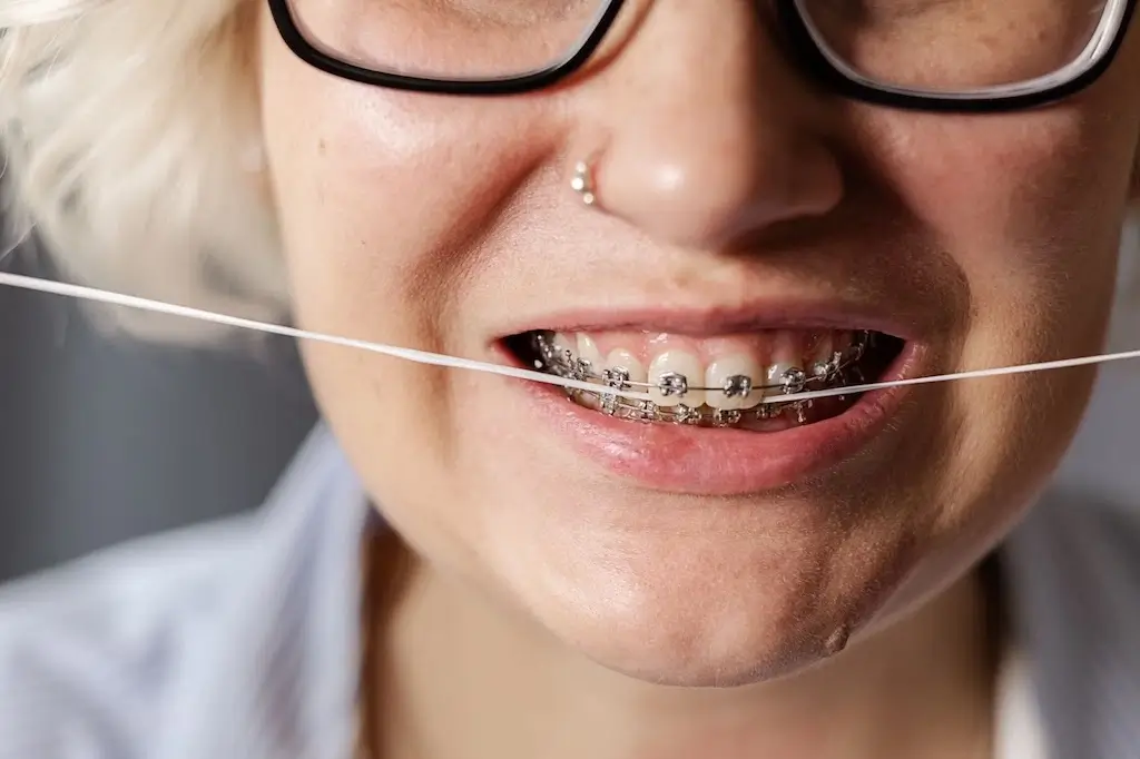 A close-up of a young woman wearing braces while flossing her teeth, highlighting the oral care routine associated with traditional braces in the Invisalign vs braces comparison.