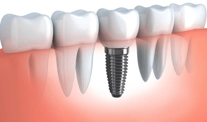 A diagram of the process of dental implants. Showing how effective and worth it the dental implant cost are