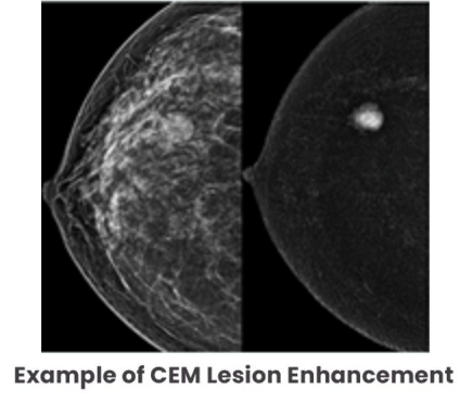 breast scan imaging comparison. An example of CEM enhancement showing a leision and one without CEM enhancement