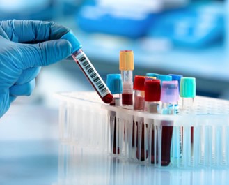 A hand with blue urgical glove on taking a vile of blood out of a container with other vials of blood sitting on a clinical bench