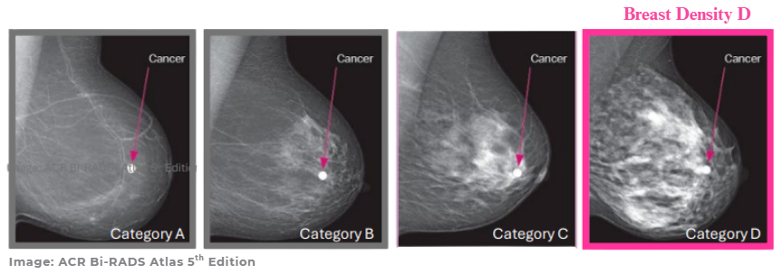 A close-up of a breast x-rayAI-generated content may be incorrect.