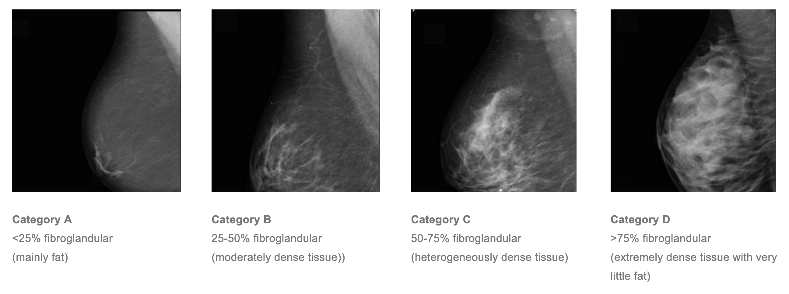 4 images of breast scans showing category a as the least dense through to category b as the most dense