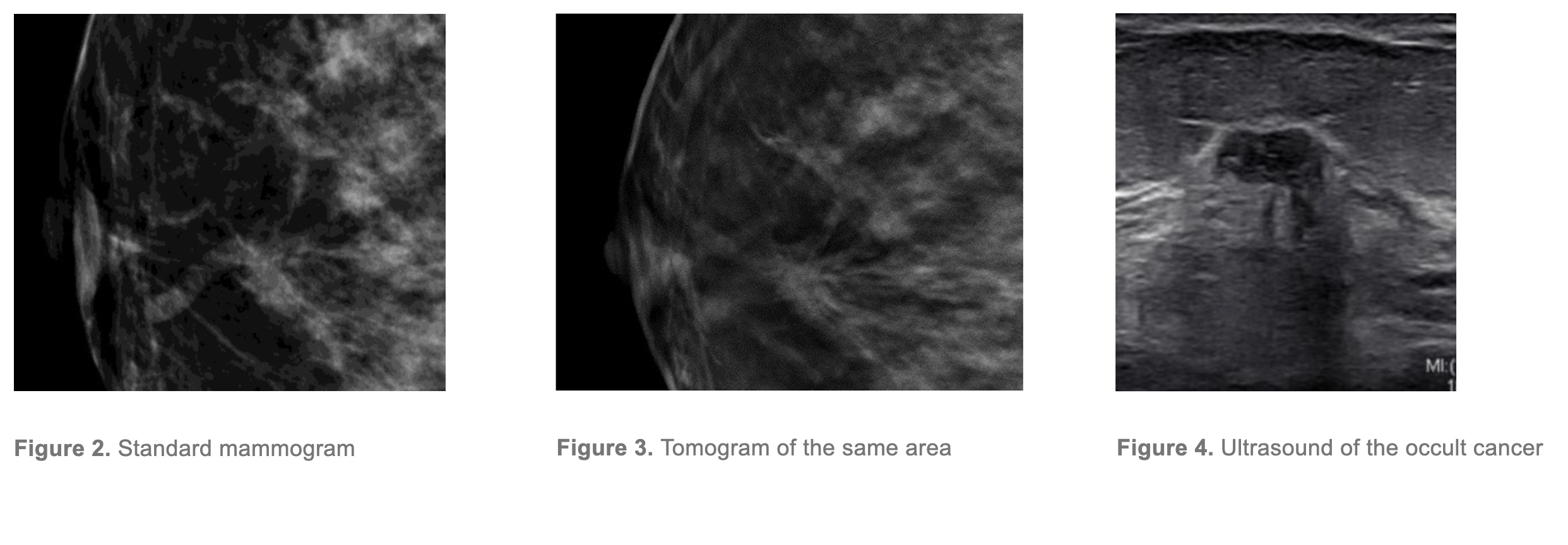 3 breast scans with the first one showing standard mammoram. second one showing tomogram of the same area and 3rd one showing ultrasound of the occult cancer