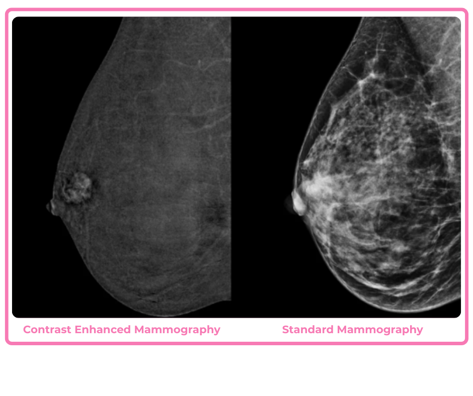 Breast imaging showing contrast enhanced mammography on the left and standard mammography on the right. 