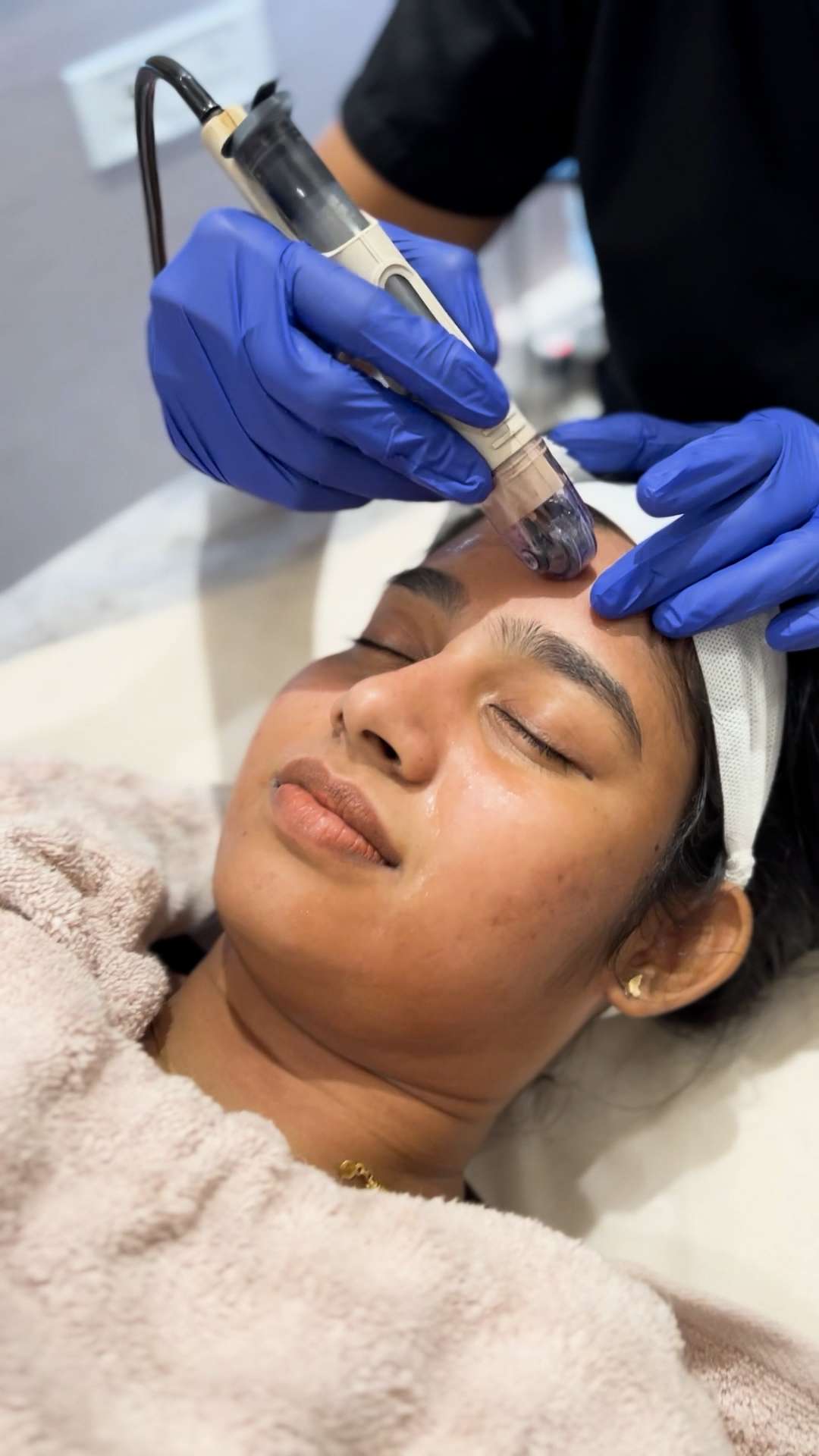Dermafrac microneedling and serum infusion technology