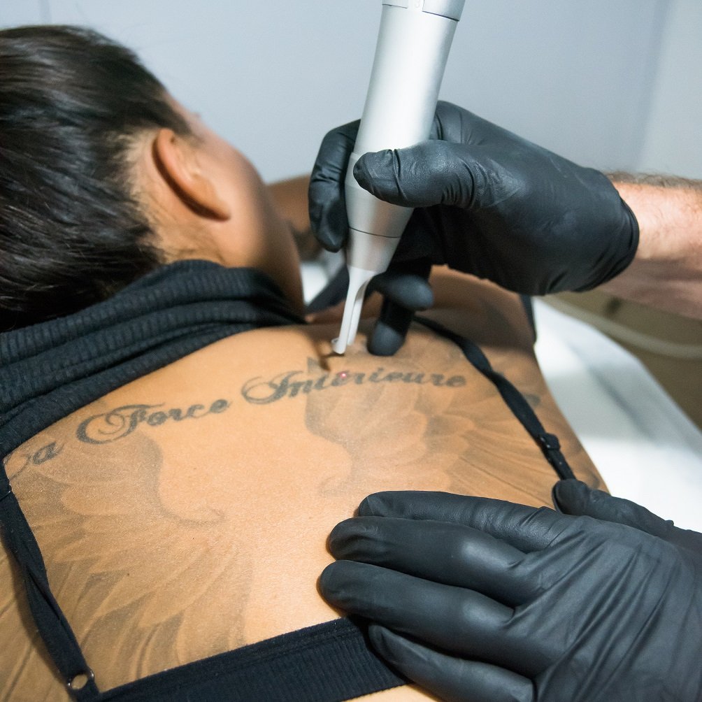 Tips To Prepare Yourself Before Getting Laser Tattoo Removal