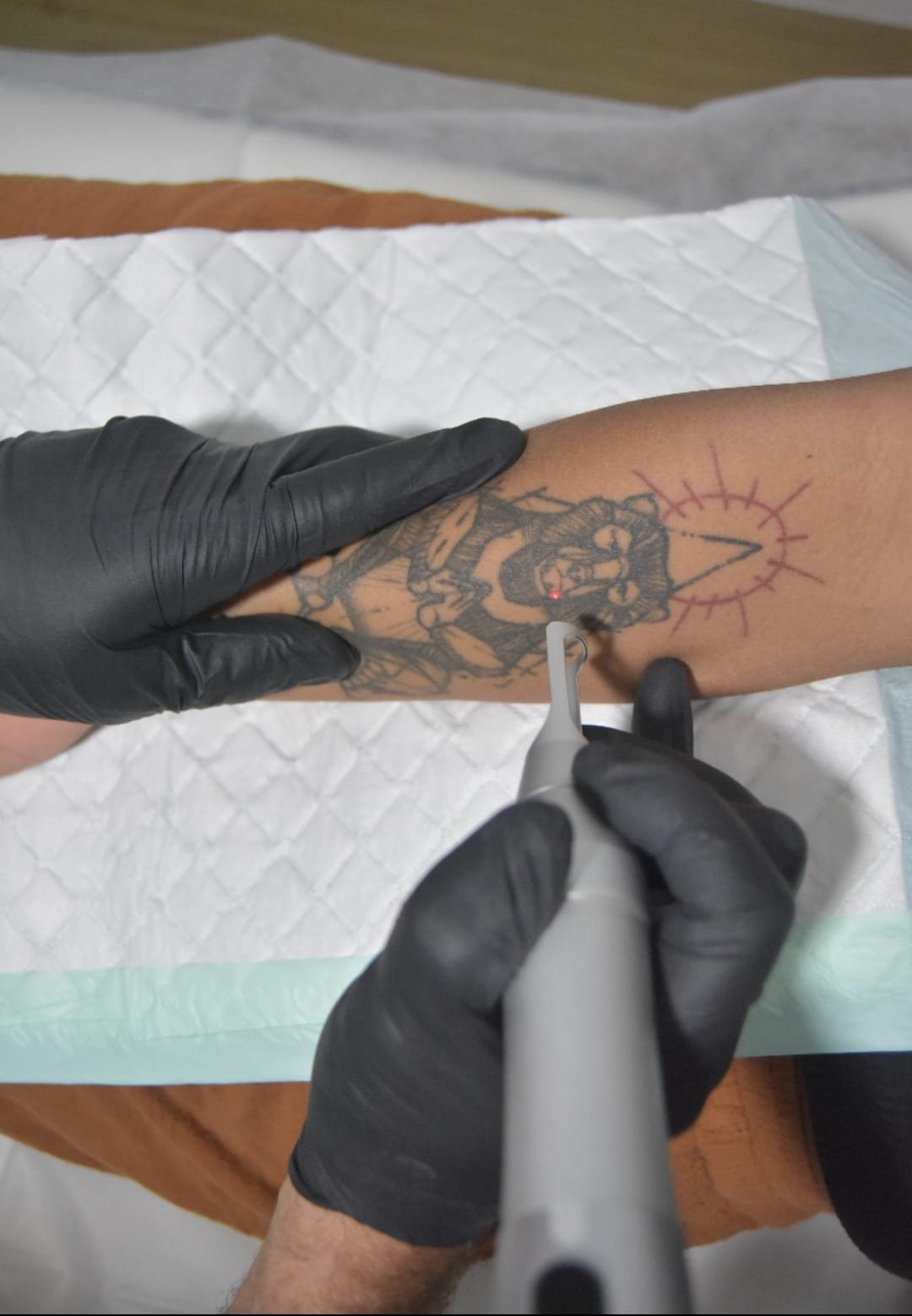 5 Potential Reasons People Seek Out Tattoo Removal Services