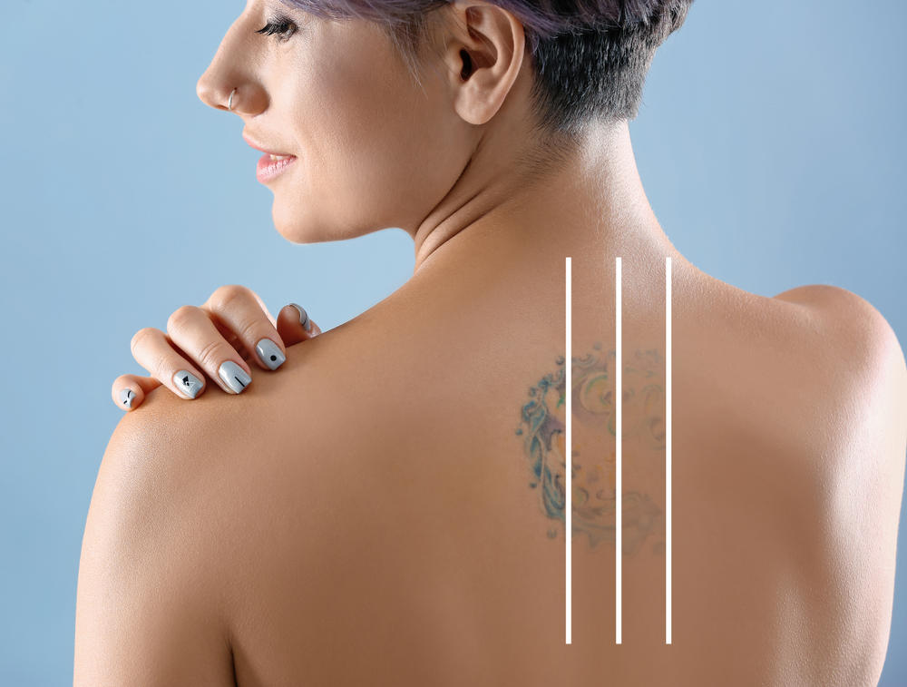 Laser Tattoo Removal: A Guide to Aftercare Treatment