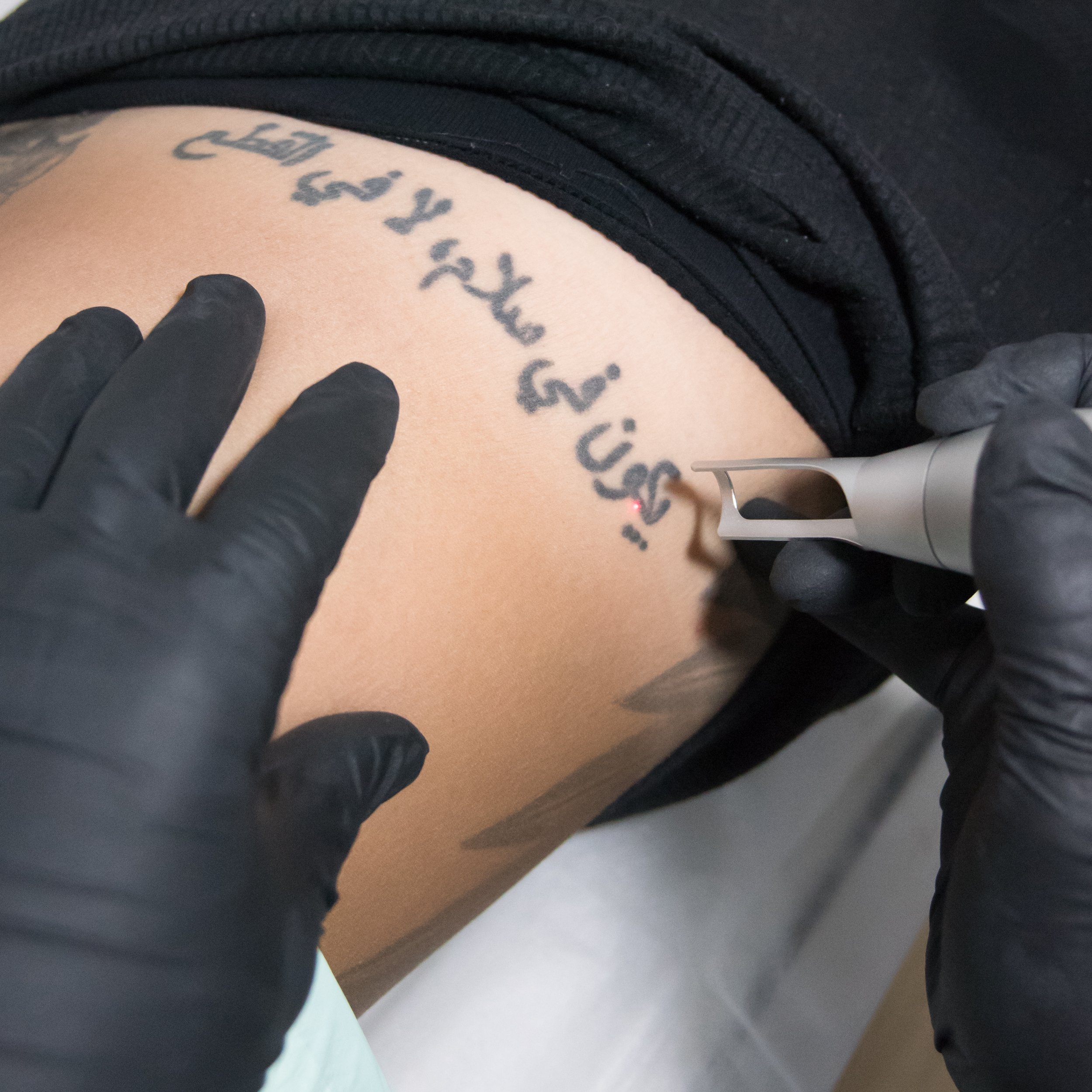 Top 5 Factors That Affect A Laser Tattoo Removal Progress