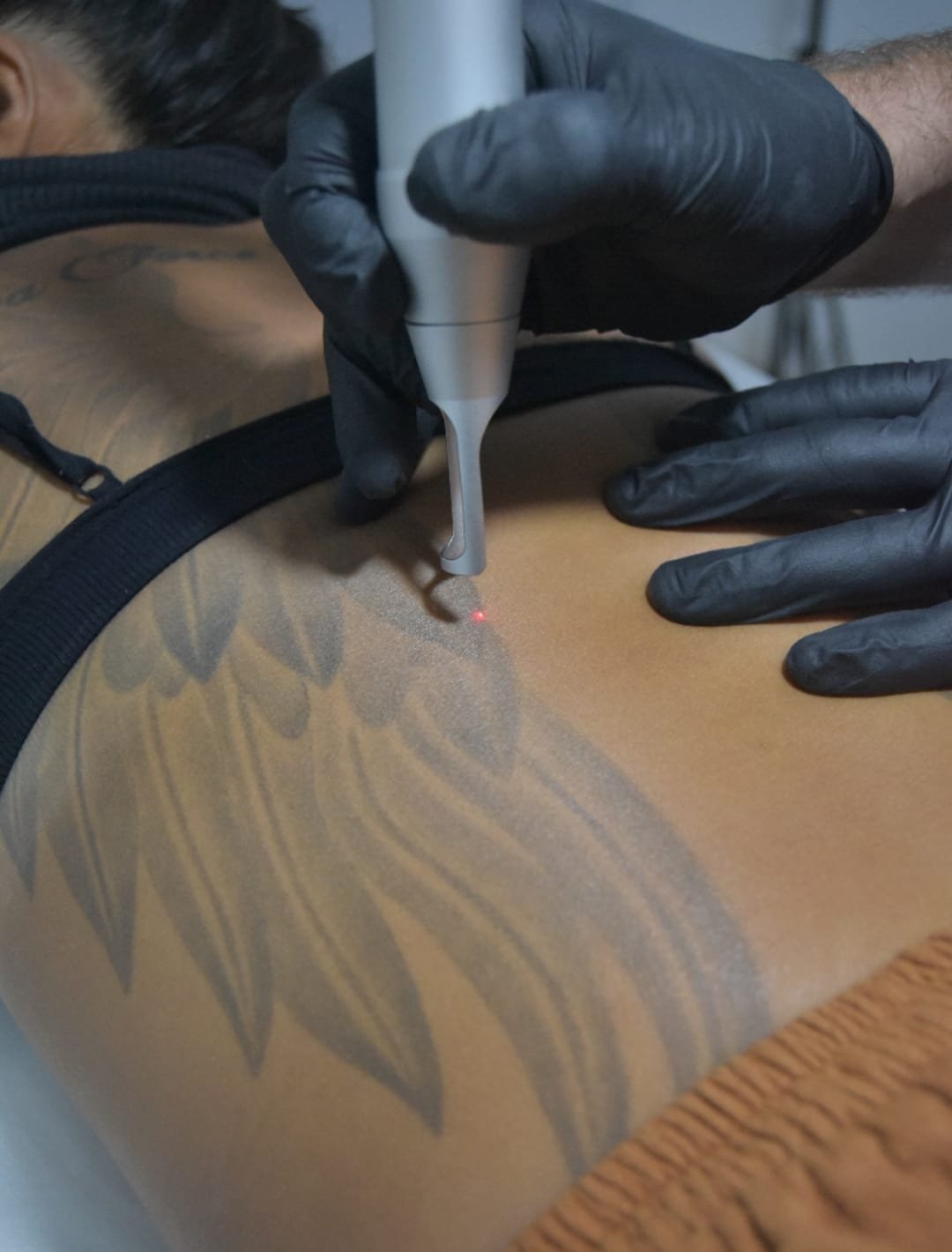Top 6 Common Reasons Why People Want a Tattoo Removal