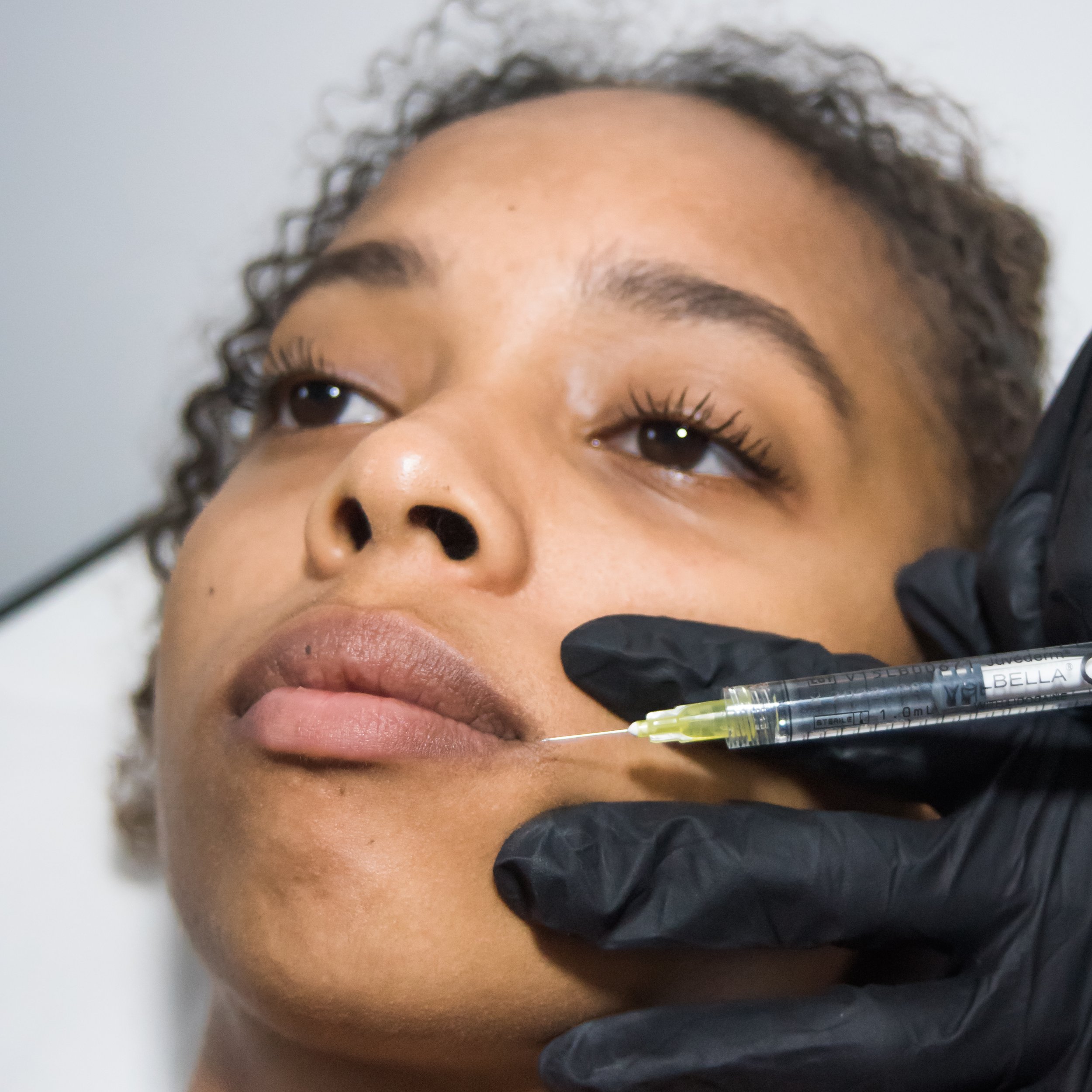 What To Consider Before Getting Lip Fillers