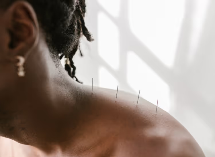 Your Guide to Post-Acupuncture Care