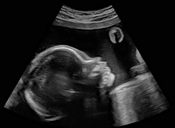 2D ultrasound