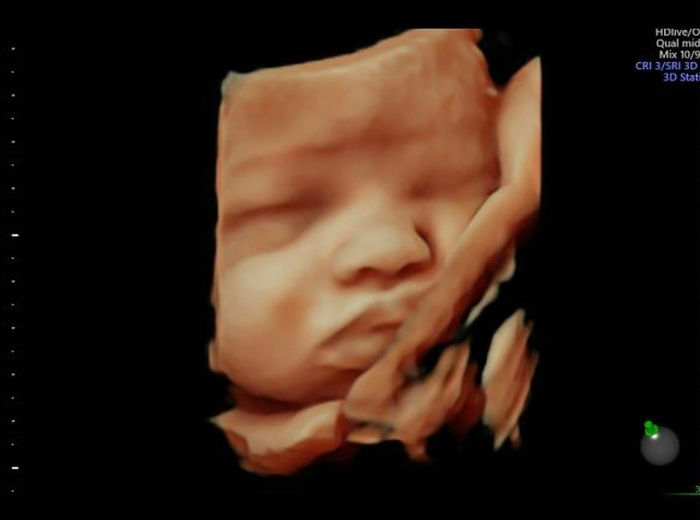 3D Ultrasound