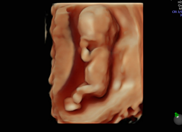 Nuchal Translucency