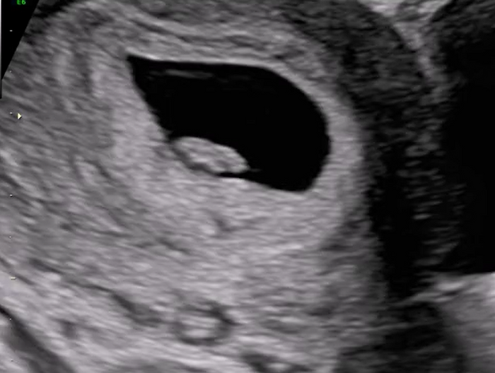 First Trimester