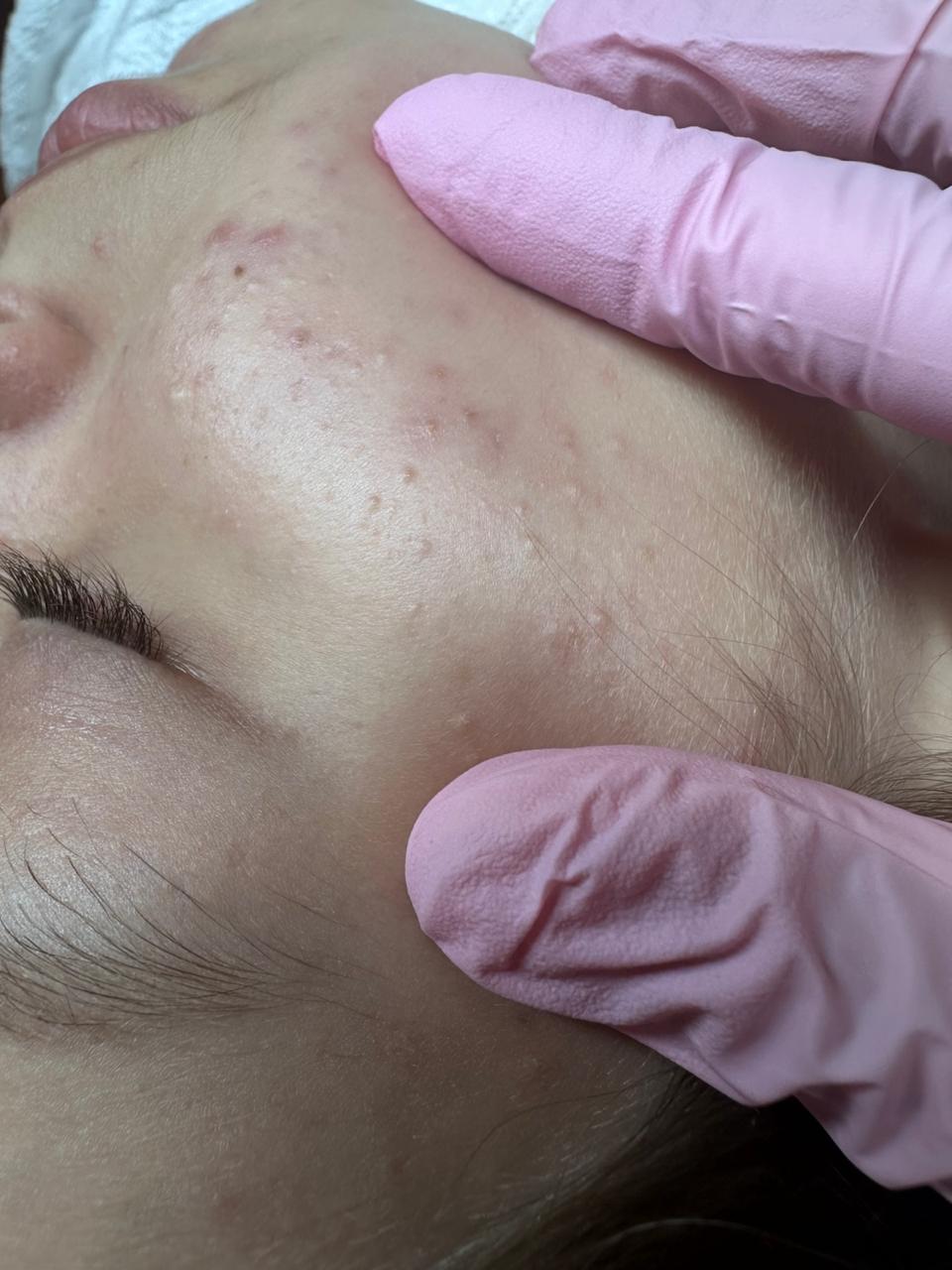 Close-up of a person's cheek with mild acne and a hand wearing pink latex gloves gently touching the skin.
