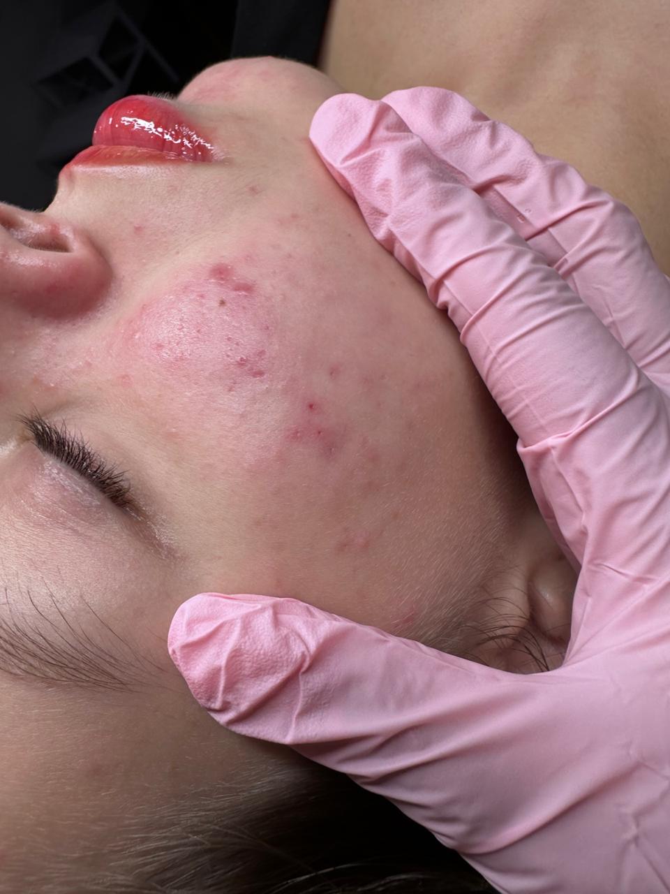 Close-up of a person's cheek showing smooth, clean, and radiant skin after a facial treatment.