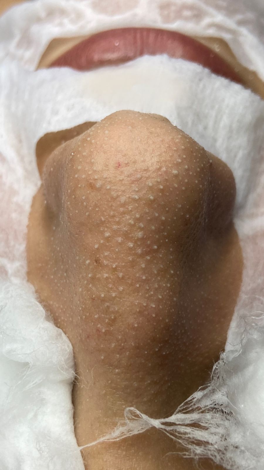 Close-up of a nose with numerous small whiteheads or blackheads, surrounded by white gauze.