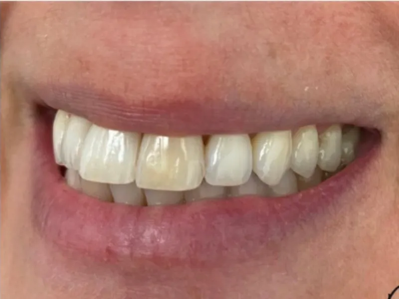 Before and after discoloration correction and porcelain veneers in Chino Hills CA