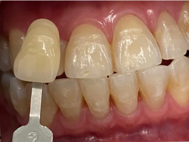 Teeth whitening shade guide transformation – Omnia Dental Care Chino Hills