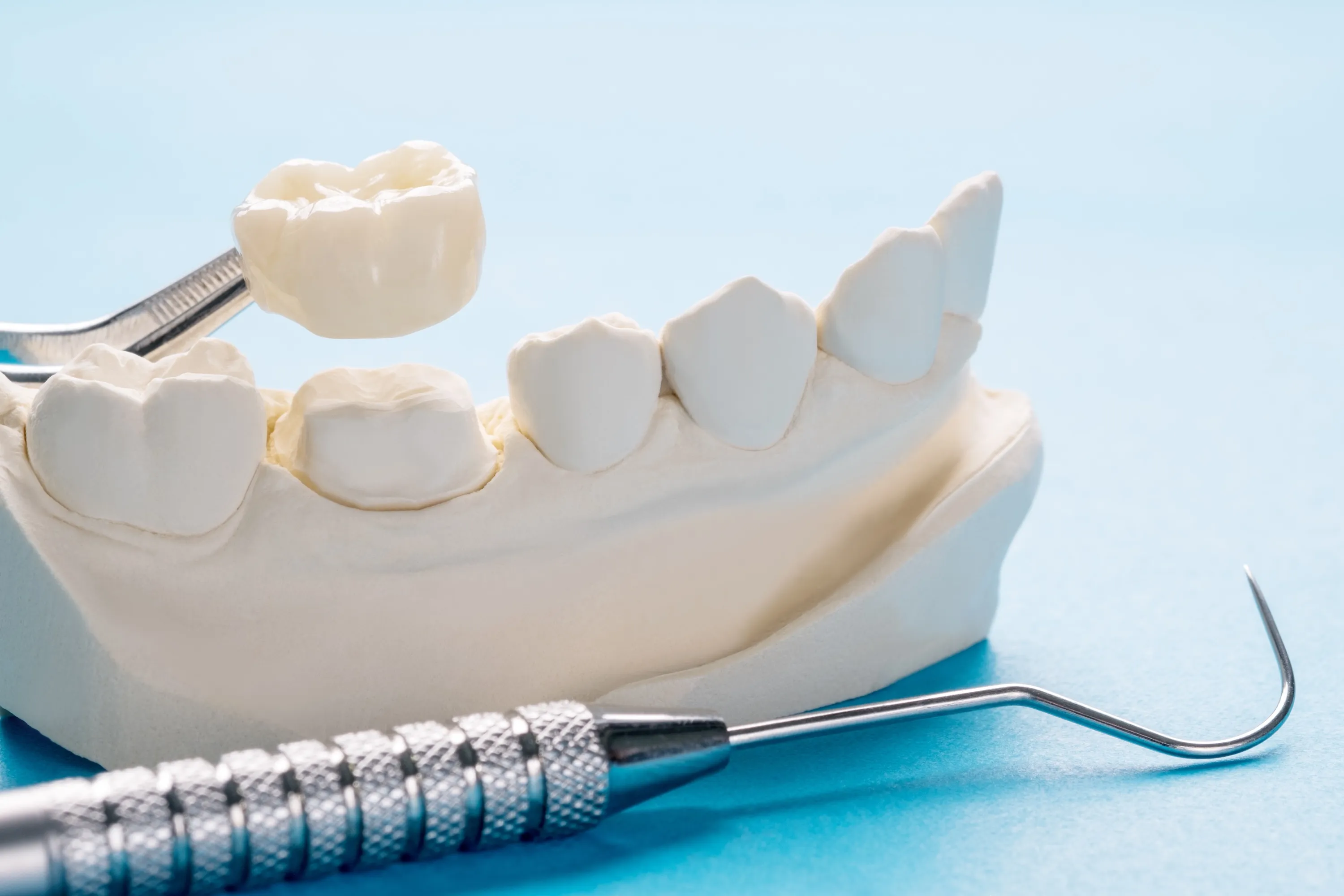 Porcelain dental crown placement at Omnia Dental Care in Chino Hills CA