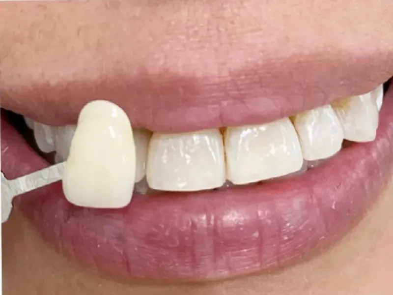 Teeth whitening shade guide transformation – Omnia Dental Care Chino Hills