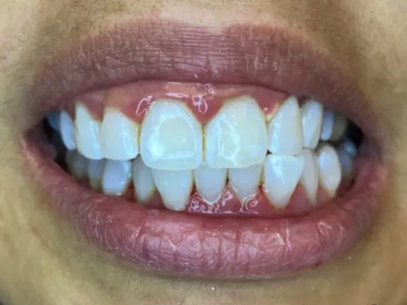 after professional teeth whitening at Omnia Dental Care in Chino Hills CA