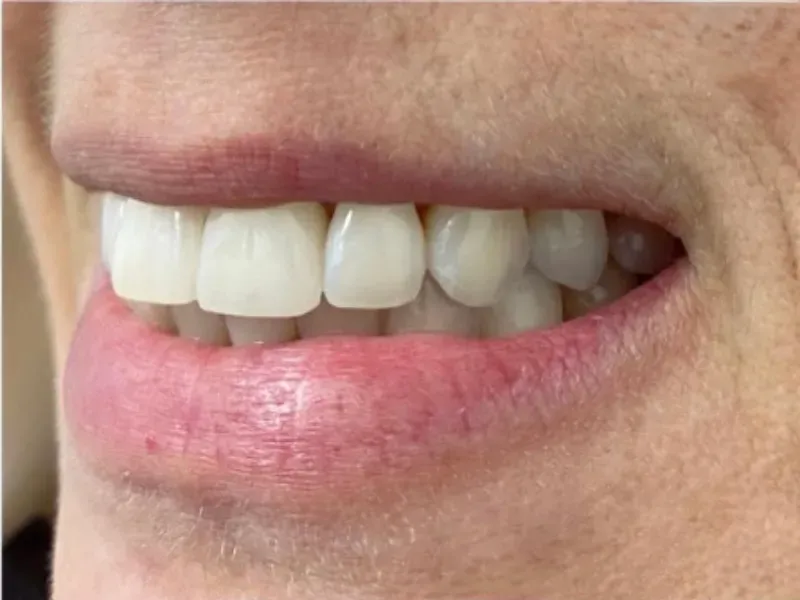 Before and after discoloration correction and porcelain veneers in Chino Hills CA