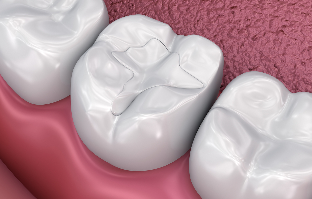 Dental Sealants in Somerset, NJ – Prevent Cavities Before They Start