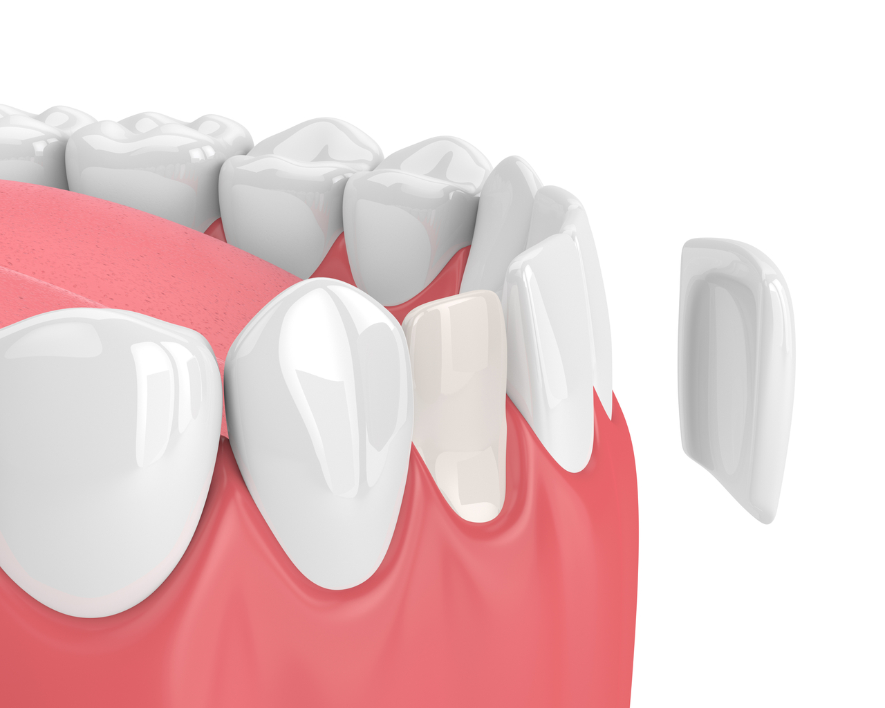 Tooth-Colored Fillings in Somerset, NJ – Natural-Looking Cavity Repair