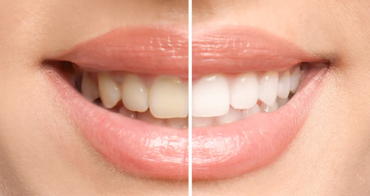 Teeth Whitening in Somerset, NJ | Brighten Your Smile with Confidence