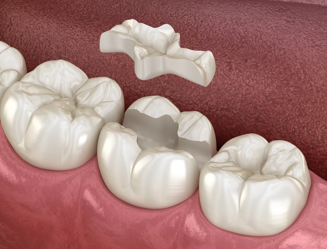 Inlays and Onlays in Somerset, NJ | Strong, Precise Tooth Restoration