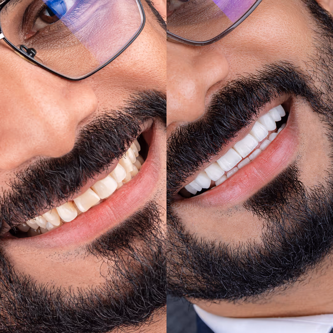 Patient Treatment Result at Skin Symphony