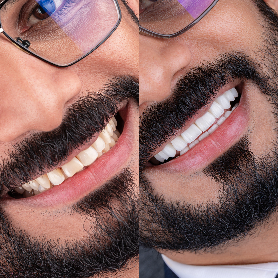 Patient Treatment Result at Skin Symphony